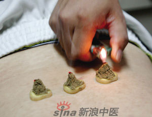灸法的種類  你知道多少？